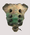 Sacralizáció, amely során az első farokcsigolya összenőtt a felette elhelyezkedő  keresztcsonti csigolyával